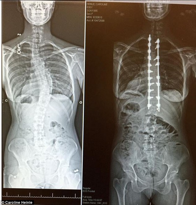 Curved: She was diagnosed with scoliosis at the age of 15, but the condition of her back steadily worsened