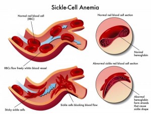 sickle-cell-black-men-2015