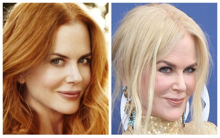 Shocking Before-and-After Celebrity Plastic Surgery