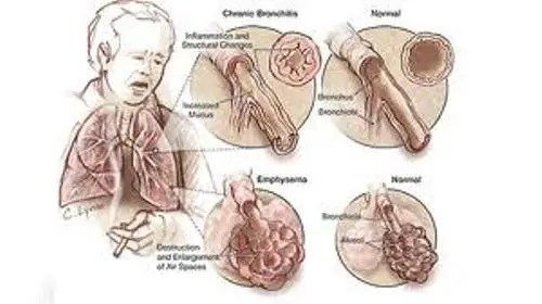 Cystic Fibrosis Disease