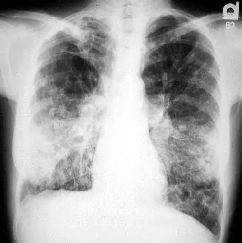 Cystic Fibrosis with Lung Infection